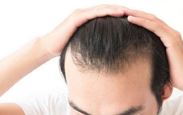 Vuốt tóc nhiều có bị hói đầu không?