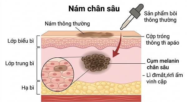 Trị Nám Chân Sâu Có Khó Không?