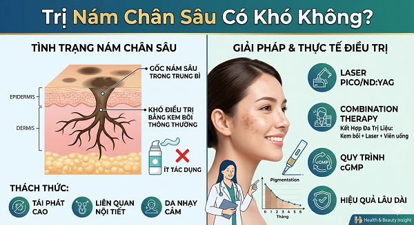 Trị Nám Chân Sâu Có Khó Không?